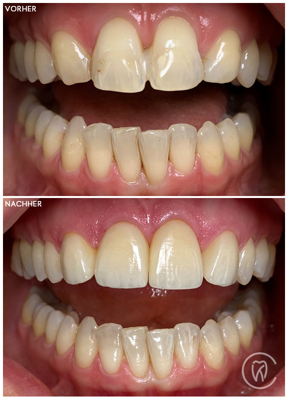 Vorher Nachher Dr. Christoph Kronsteiner Ihr Zahnarzt in LinzLeonding